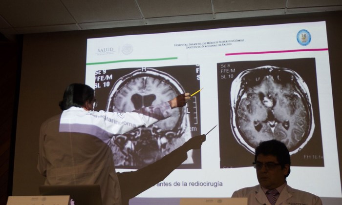 Operan tumores de cerebro... ¡sin abrir!