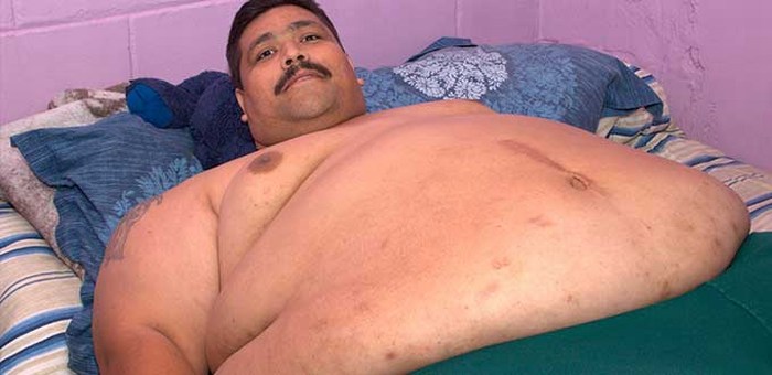 Operan con éxito al hombre más obeso del mundo en Guadalajara
