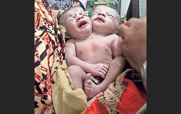 Nace niña con dos cabezas en Bangladesh