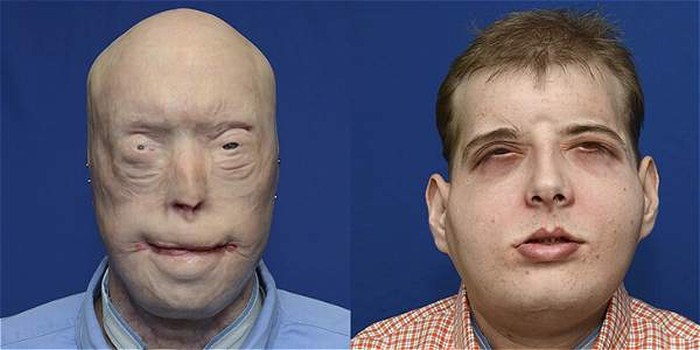 Realizan el trasplante facial más complejo hasta el momento