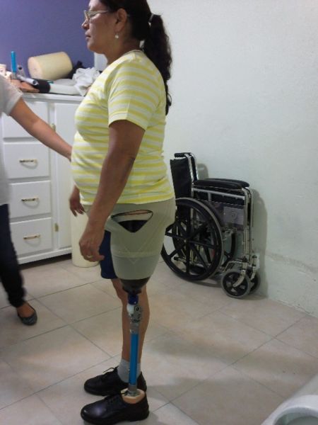 CAPACITARÁN EN EL GABY BRIMMER A PACIENTES CON PRÓTESIS DONADOS POR EL DIF.