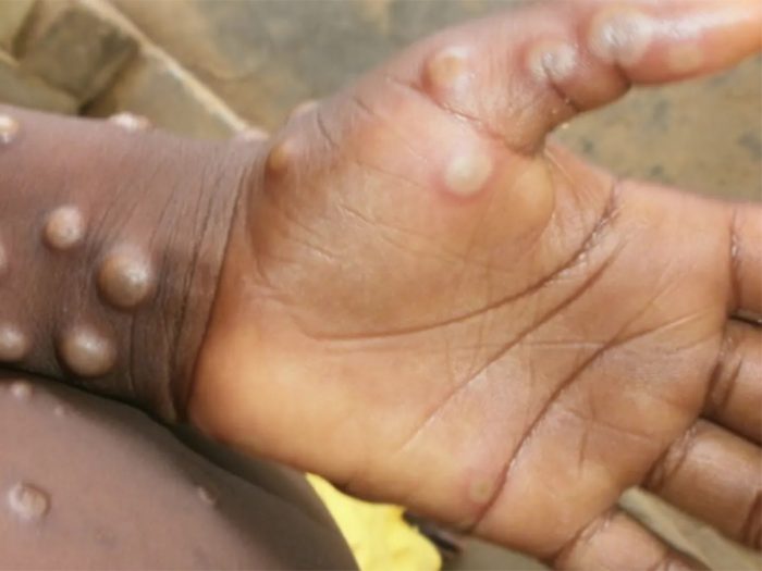 Enfermedad viruela del mono, explicada: síntomas, tratamiento, vacuna, cómo se transmite y países afectados por su más reciente brote