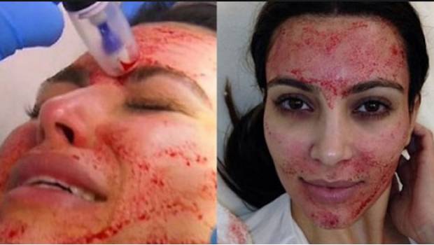 "Facial de vampiro" contagió de VIH a clientes de un spa
