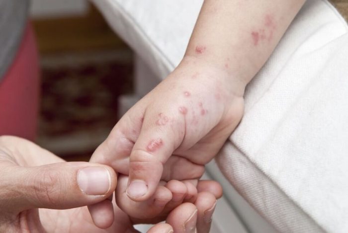 Virus coxsackie: ¿Qué es, cómo se contagia y a quiénes afecta?