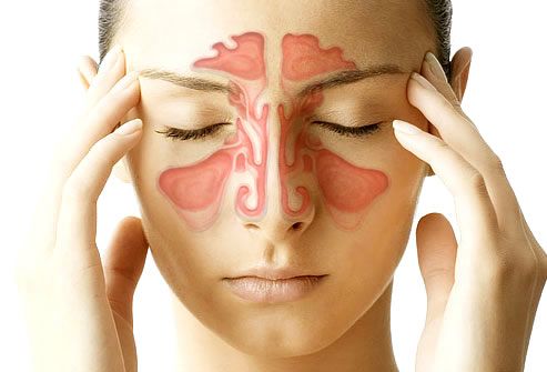 Sinusitis: ¿Qué es, cuáles son los síntomas y las causas de su aparición?