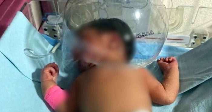 Indignación en Tabasco: atienden a bebé con botella de plástico en IMSS-Bienestar