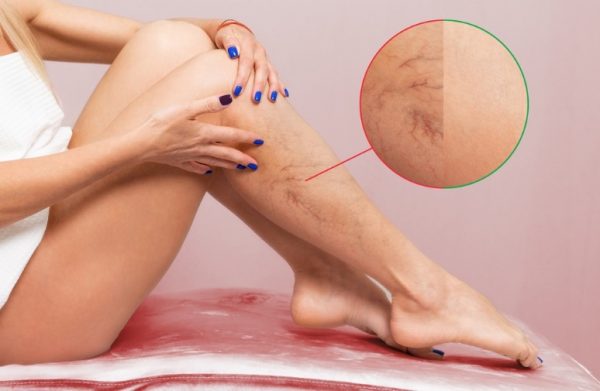 ¿Qué son las várices, por qué aparecen y cuáles son los nuevos tratamientos sin cirugía para eliminarlas?